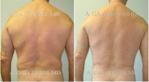 Male Liposuction - Patient A