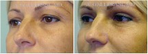 Blepharoplasty - Patient A