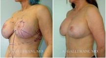 Breast Reconstruction - Patient M