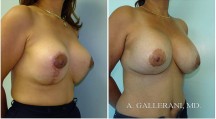 Breast Reconstruction - Patient O