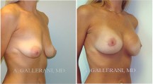 Breast Lift - Patient B