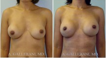 Breast Reconstruction - Patient B
