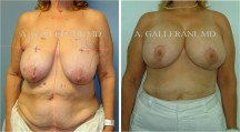 Breast Lift - Patient D