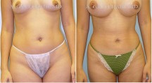Liposuction - Patient D
