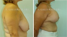 Breast Lift - Patient D