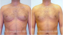 Gynecomastia (Male Breast Reduction) - Patient E