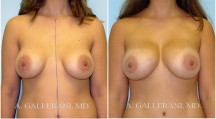 Breast Reconstruction - Patient E