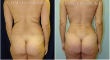 Liposuction - Patient F