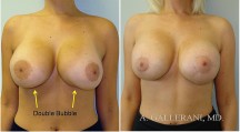 Breast Reconstruction - Patient G