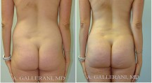 Liposuction - Patient G