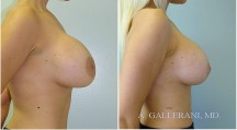 Breast Reconstruction - Patient G