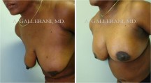 Breast Lift - Patient E