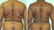 Liposuction - Patient H