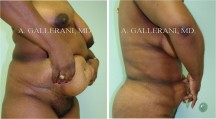 Liposuction - Patient H
