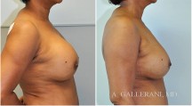 Breast Reconstruction - Patient I