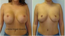 Breast Reconstruction - Patient J