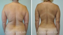 Liposuction - Patient I