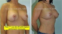 Breast Lift - Patient G