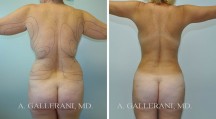 Liposuction - Patient I