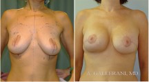 Breast Reconstruction - Patient L