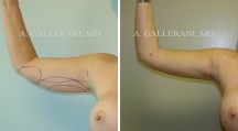 Liposuction - Patient J
