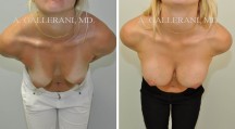 Breast Lift - Patient H