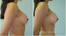 Breast Reconstruction - Patient C