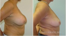 Breast Reconstruction - Patient N