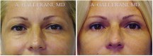 Blepharoplasty - Patient A