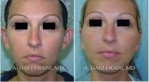 Otoplasty - Patient C