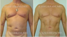 Male Liposuction - Patient A