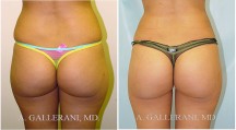 Buttocks - Patient A