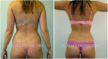Liposuction - Patient A