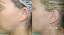 Otoplasty - Patient C