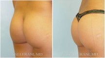 Buttocks - Patient A