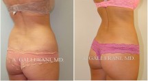 Liposuction - Patient A