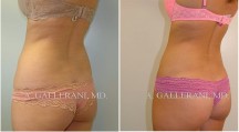 Liposuction - Patient A