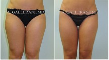 Liposuction - Patient B