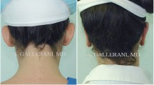 Otoplasty - Patient A