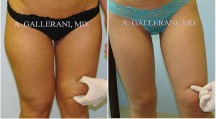 Liposuction - Patient B