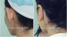Otoplasty - Patient A