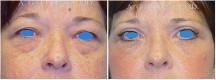 Blepharoplasty - Patient J