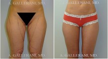 Liposuction - Patient C