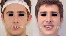 Otoplasty - Patient B