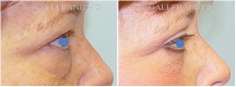 Blepharoplasty - Patient J