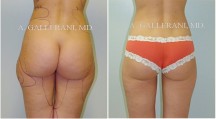 Liposuction - Patient C