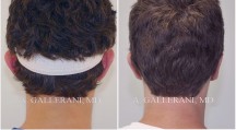 Otoplasty - Patient B