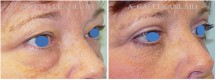 Blepharoplasty - Patient J