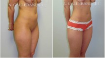 Liposuction - Patient C