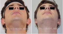 Otoplasty - Patient B